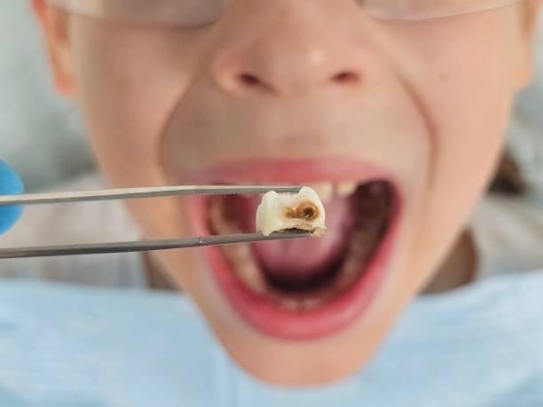 Best Emergency Root Canal Therapy in Hurt, VA